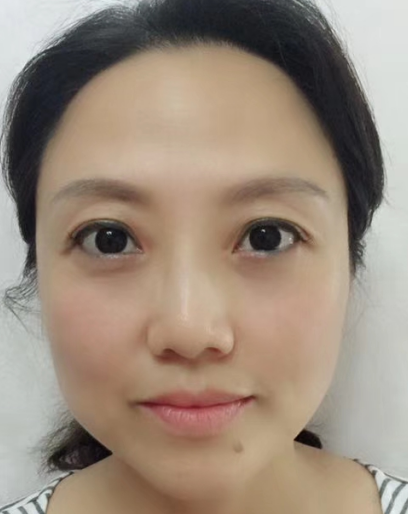 去眼袋手术