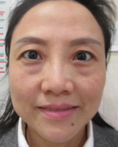 去眼袋手术