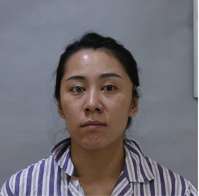 去眼袋手术