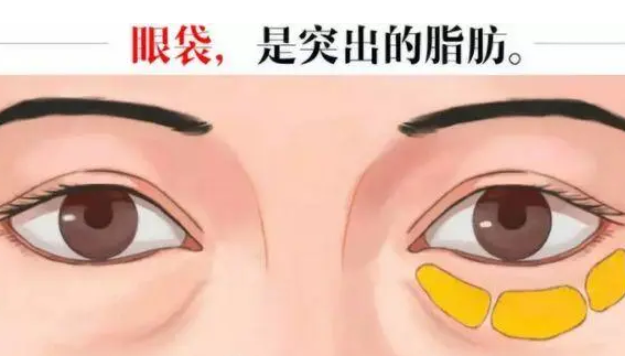 去眼袋手术
