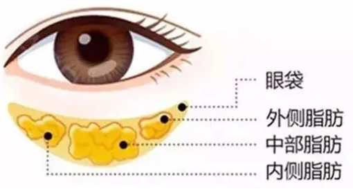 去眼袋手术