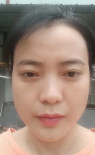 去眼袋手术