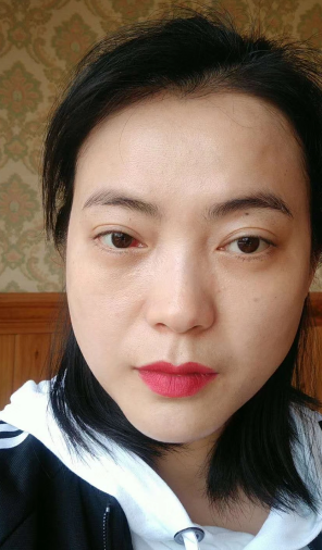 去眼袋手术