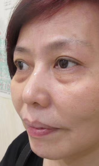 去眼袋手术