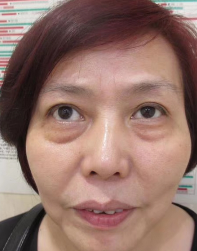 去眼袋手术