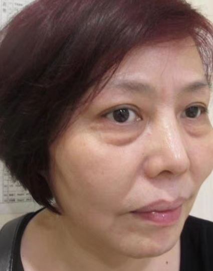 去眼袋手术