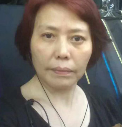 去眼袋手术