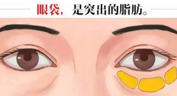 去眼袋手术