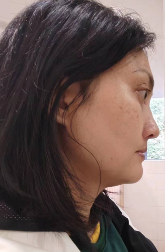 去眼袋手术