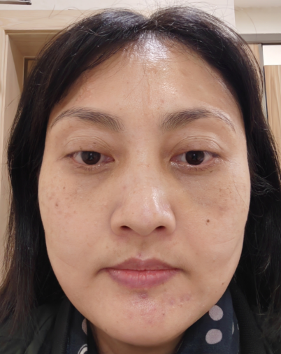 去眼袋手术