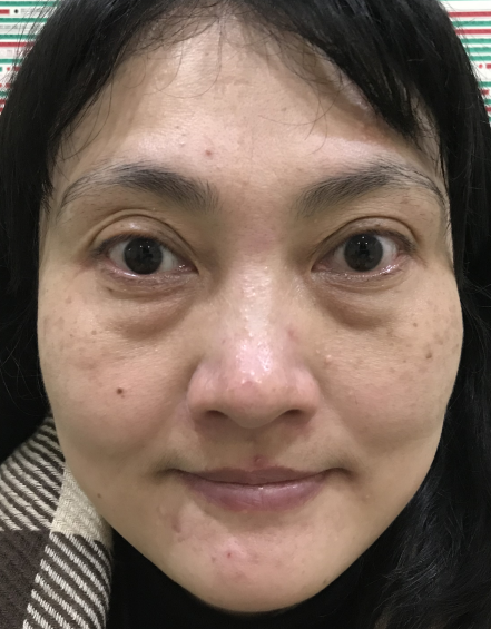 去眼袋手术