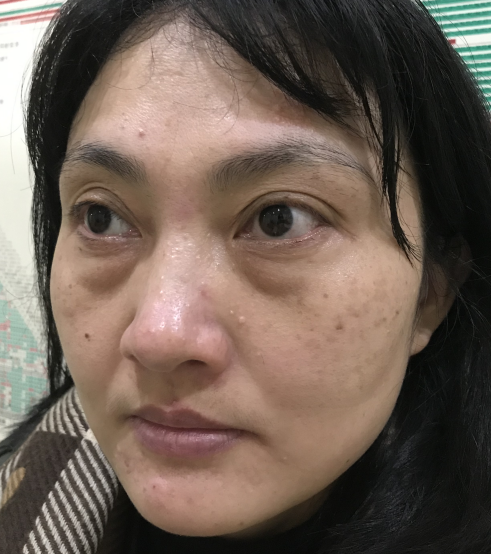 去眼袋手术