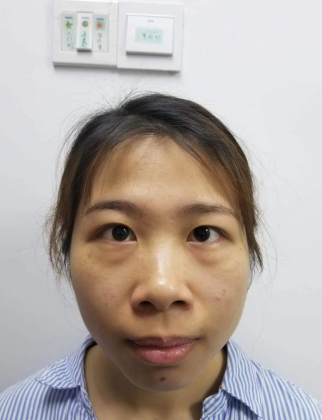 去眼袋手术