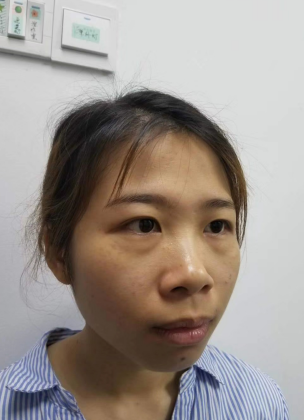 去眼袋手术