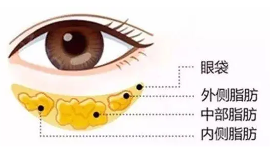 去眼袋手术