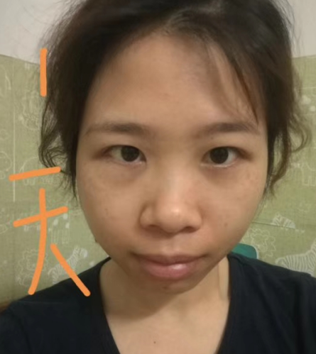 去眼袋手术