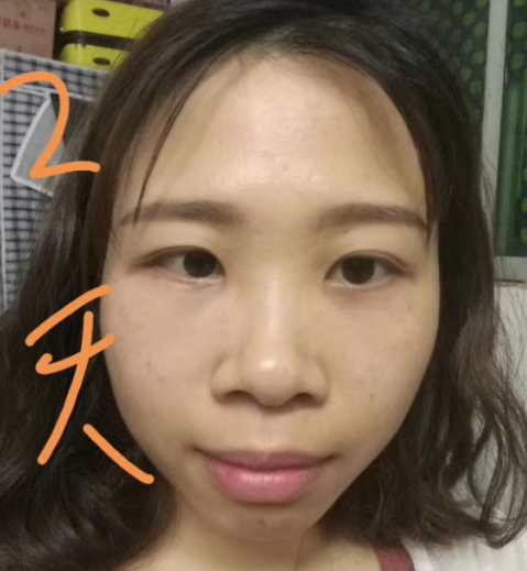 去眼袋手术
