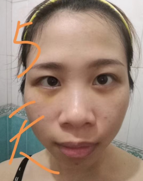 去眼袋手术