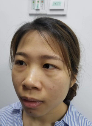 去眼袋手术
