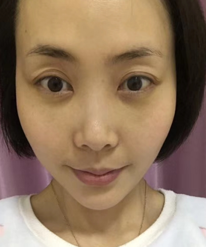 去眼袋手术