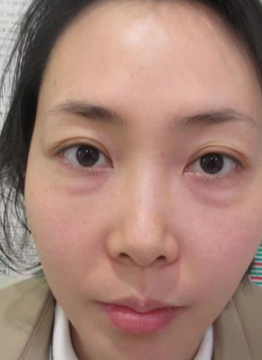 去眼袋手术