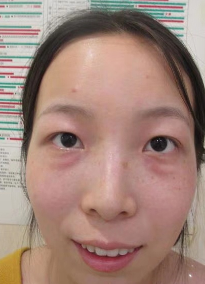 你是如何知道治眼袋的?有人给你推荐吗?169 你是如何知道治眼袋的?有人给你推荐吗?169