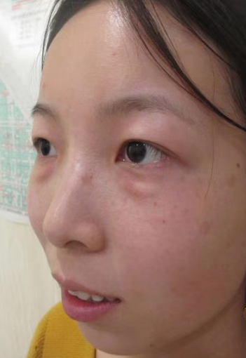 你是如何知道治眼袋的?有人给你推荐吗?169 你是如何知道治眼袋的?有人给你推荐吗?169