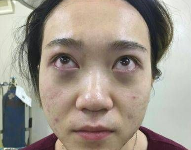 去眼袋手术