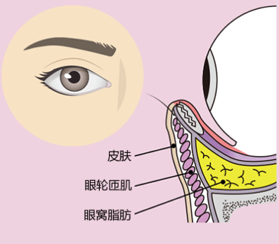 去眼袋手术