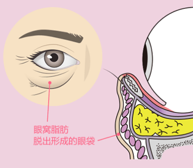去眼袋手术