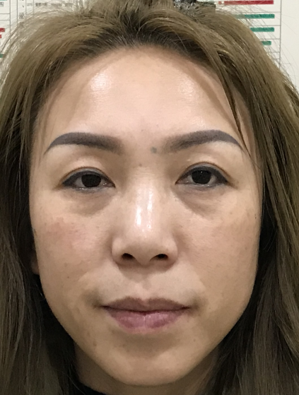 去眼袋手术