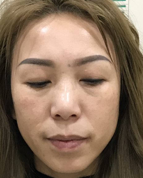 去眼袋手术