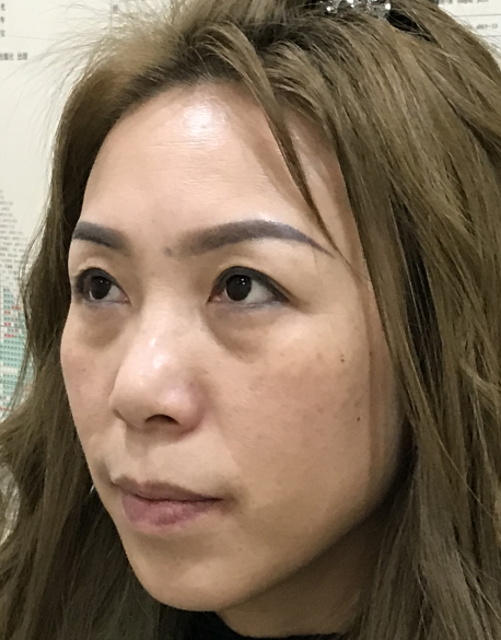 去眼袋手术