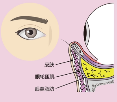去眼袋手术