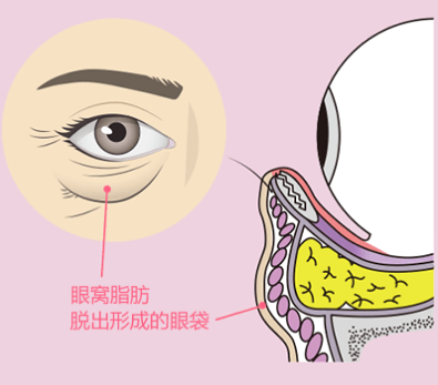 去眼袋手术