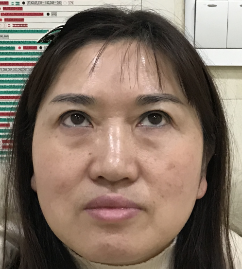 去眼袋手术