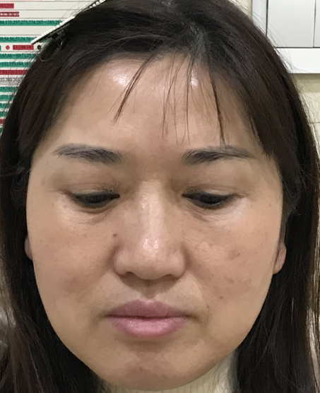 去眼袋手术