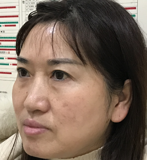 去眼袋手术