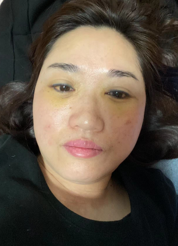 去眼袋手术