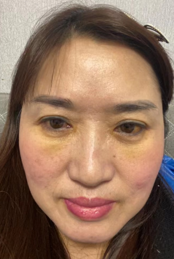 去眼袋手术