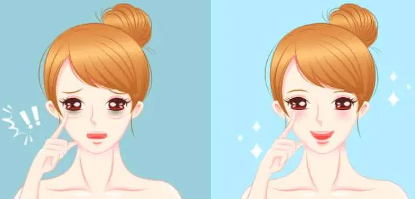 去眼袋手术