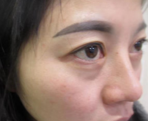 去眼袋手术