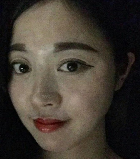 去眼袋手术