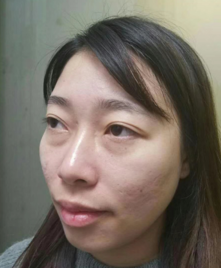 去眼袋手术