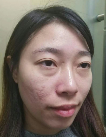 去眼袋手术