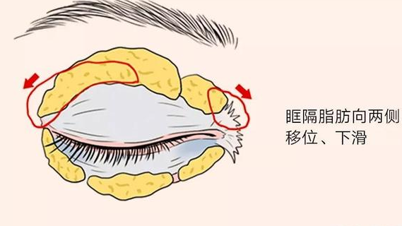 去眼袋手术