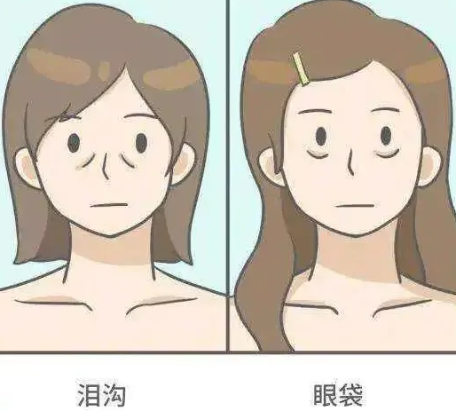 去眼袋手术