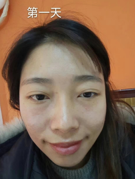 去眼袋手术