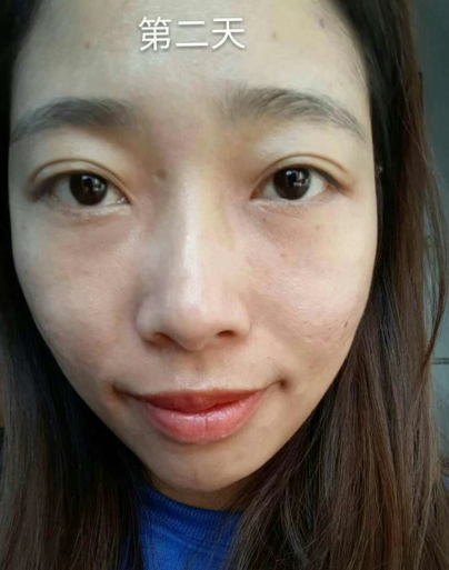 去眼袋手术