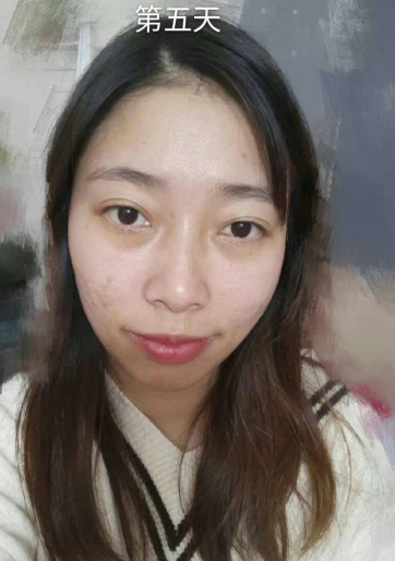 去眼袋手术